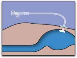 percutaneous endoscopic gastrostomy peg Gastrojejunostomy or percutaneous endoscopic gastrostomy with jejunal extension (peg-j) is a tube feeding technique which allows post-pyloric deliverance. percutaneous endoscopic gastrostomy peg Gastrojejunostomy or percutaneous endoscopic gastrostomy with jejunal extension (peg-j) is a tube feeding technique which allows post-pyloric deliverance.
