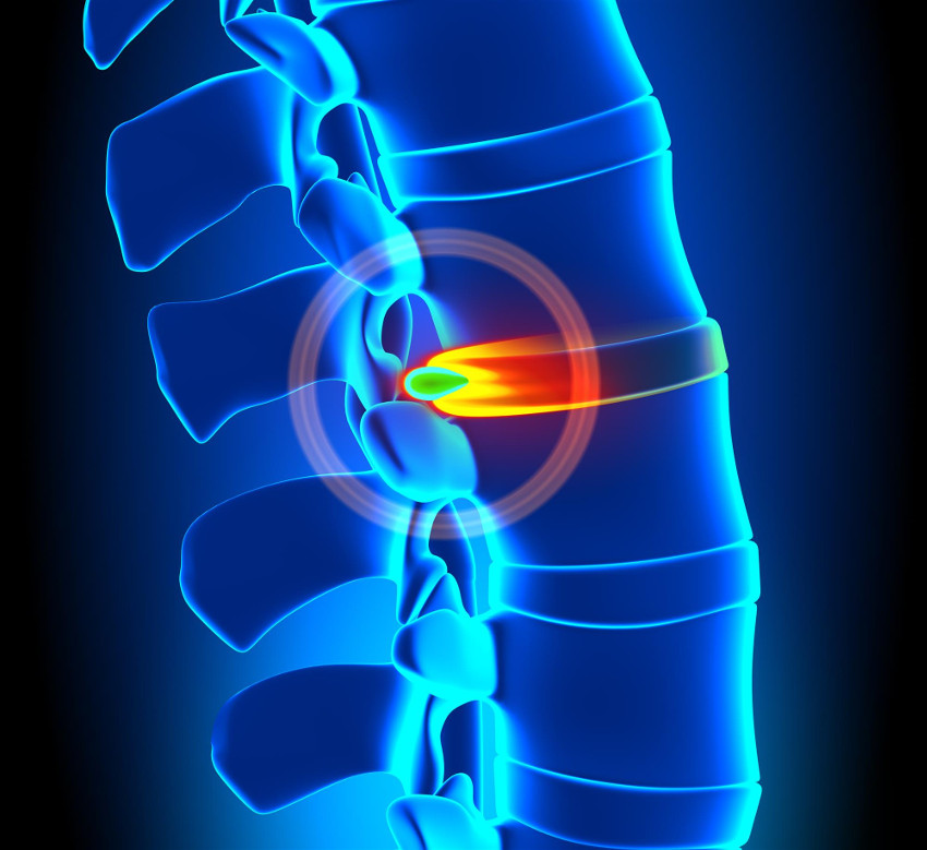 Disc related injuries and the spine