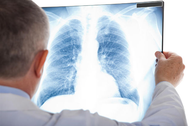 Doctor examining x-ray of lungs